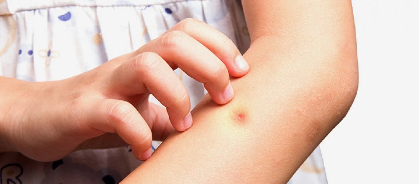 Τσίμπημα κουνουπιού: Έτσι θα εξαφανίσετε τη φαγούρα και την κοκκινίλα στο λεπτό!